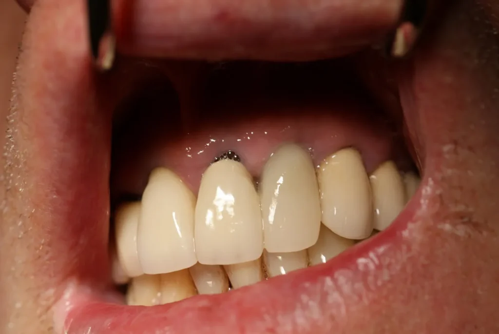 Ergebnis Implantat mit Krone regio 22 - Dr. Peter, 94424 Arnstorf
