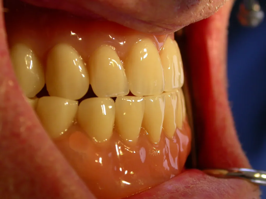 Unterkiefer-Prothese auf Miniimplantaten bei Progenie - Dr. Peter, 94424 Arnstorf