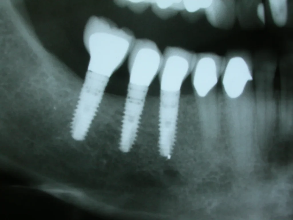 Röntgen mit Kronen auf Implantaten: Dr. Peter, 94424 Arnstorf