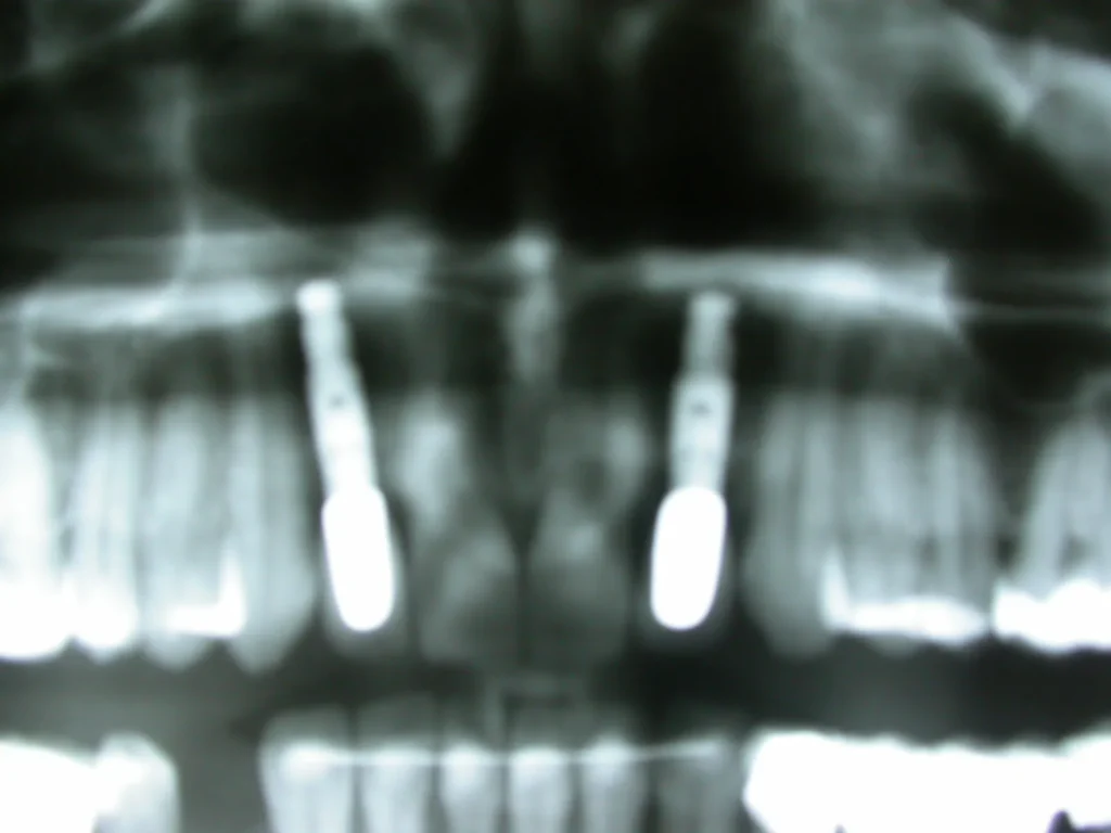 Röntgen nach Implantat-Behandlung regio 12, 22 bei Dr. Peter, Arnstorf