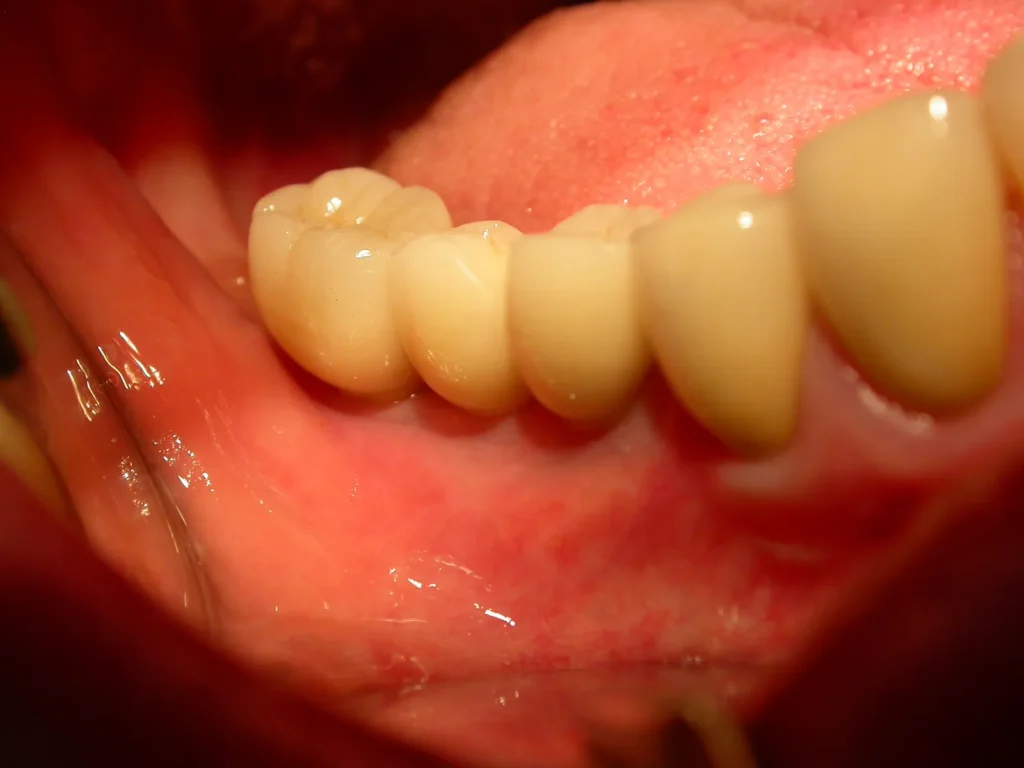 Backenzahn-Kronen auf Implantaten - Dr. Peter, 94424 Arnstorf